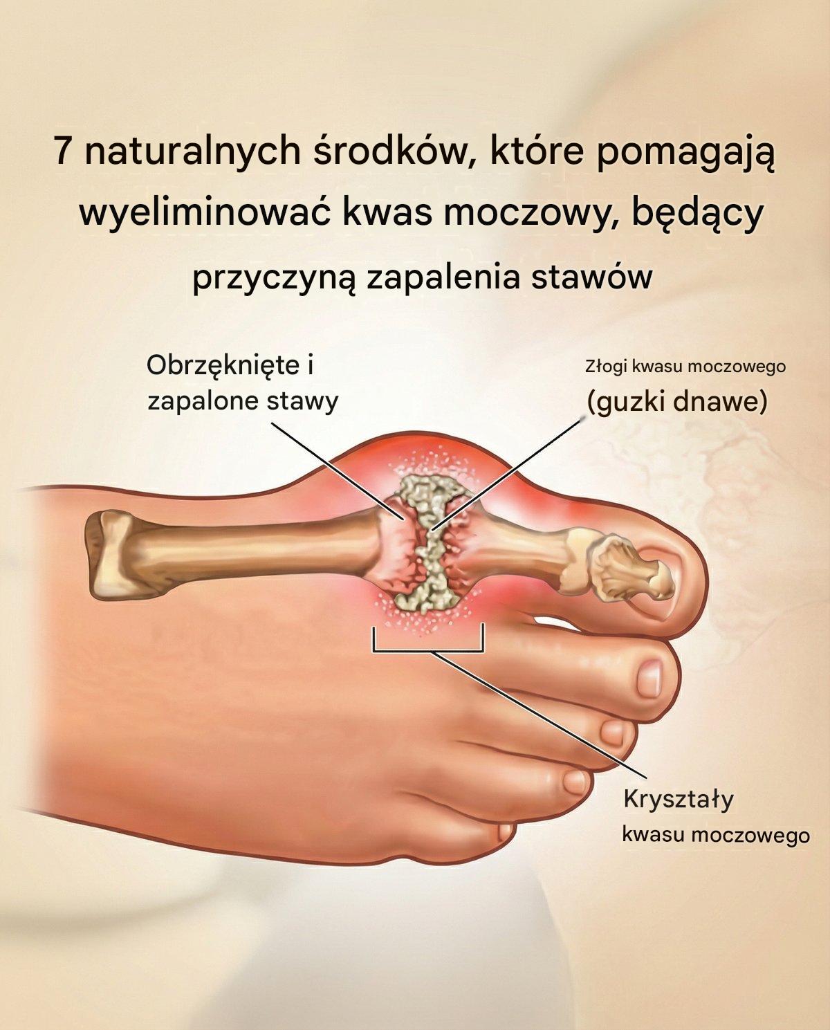 7 naturalnych środków, które pomagają wyeliminować kwas moczowy, będący przyczyną zapalenia stawów