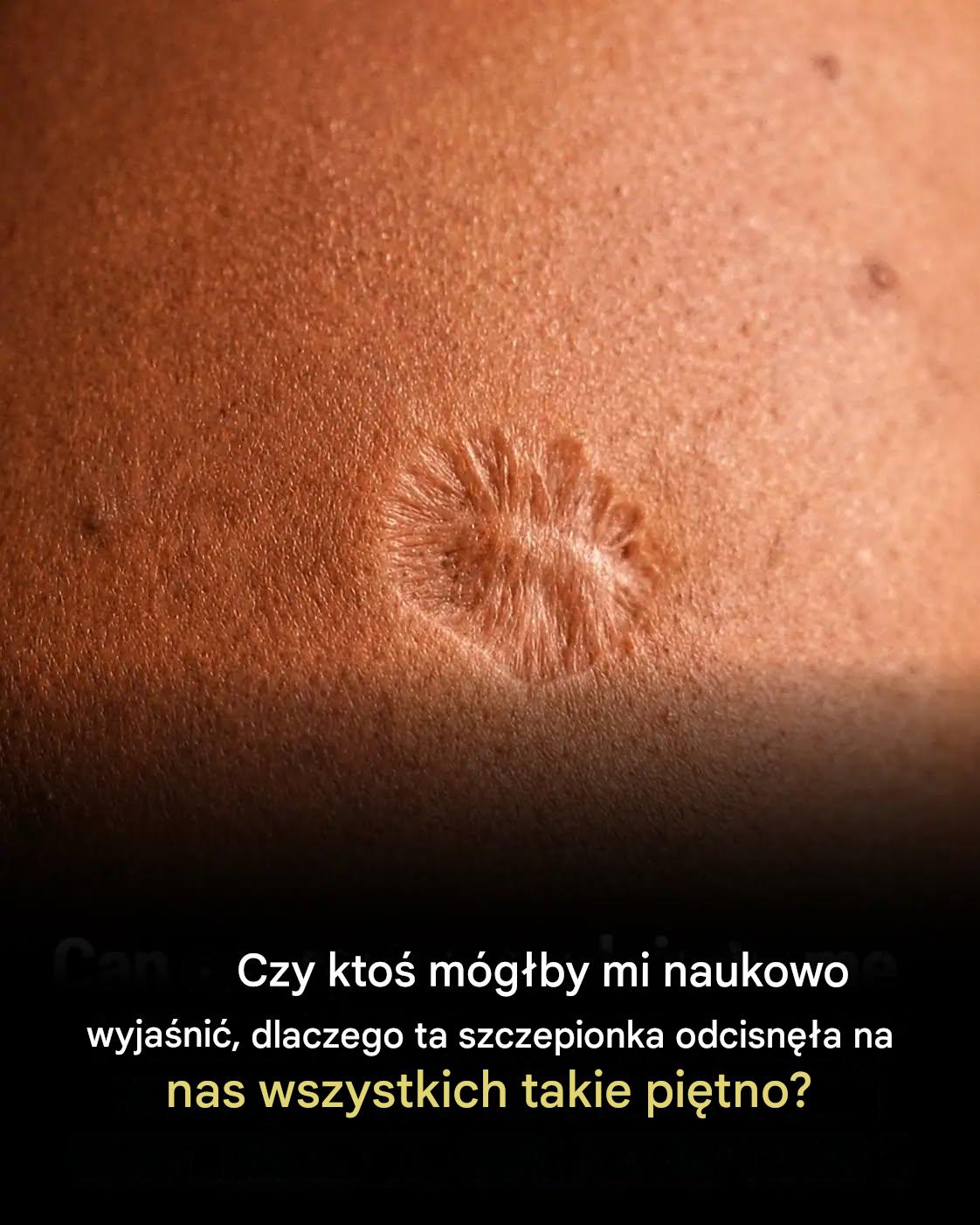 Blizna po szczepionce przeciw ospie: dlaczego tak się dzieje?