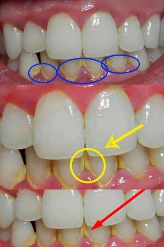 Usuń płytkę nazębną naturalnie w 5 minut, bez wizyty u dentysty.