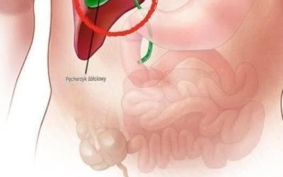 Co dzieje się z ciałem po usunięciu pęcherzyka żółciowego? 3 możliwe powikłania