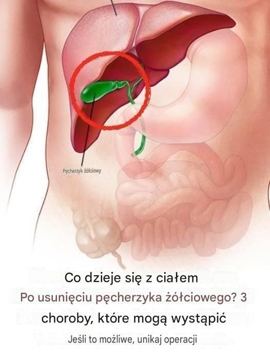 Co dzieje się z ciałem po usunięciu pęcherzyka żółciowego? 3 możliwe powikłania