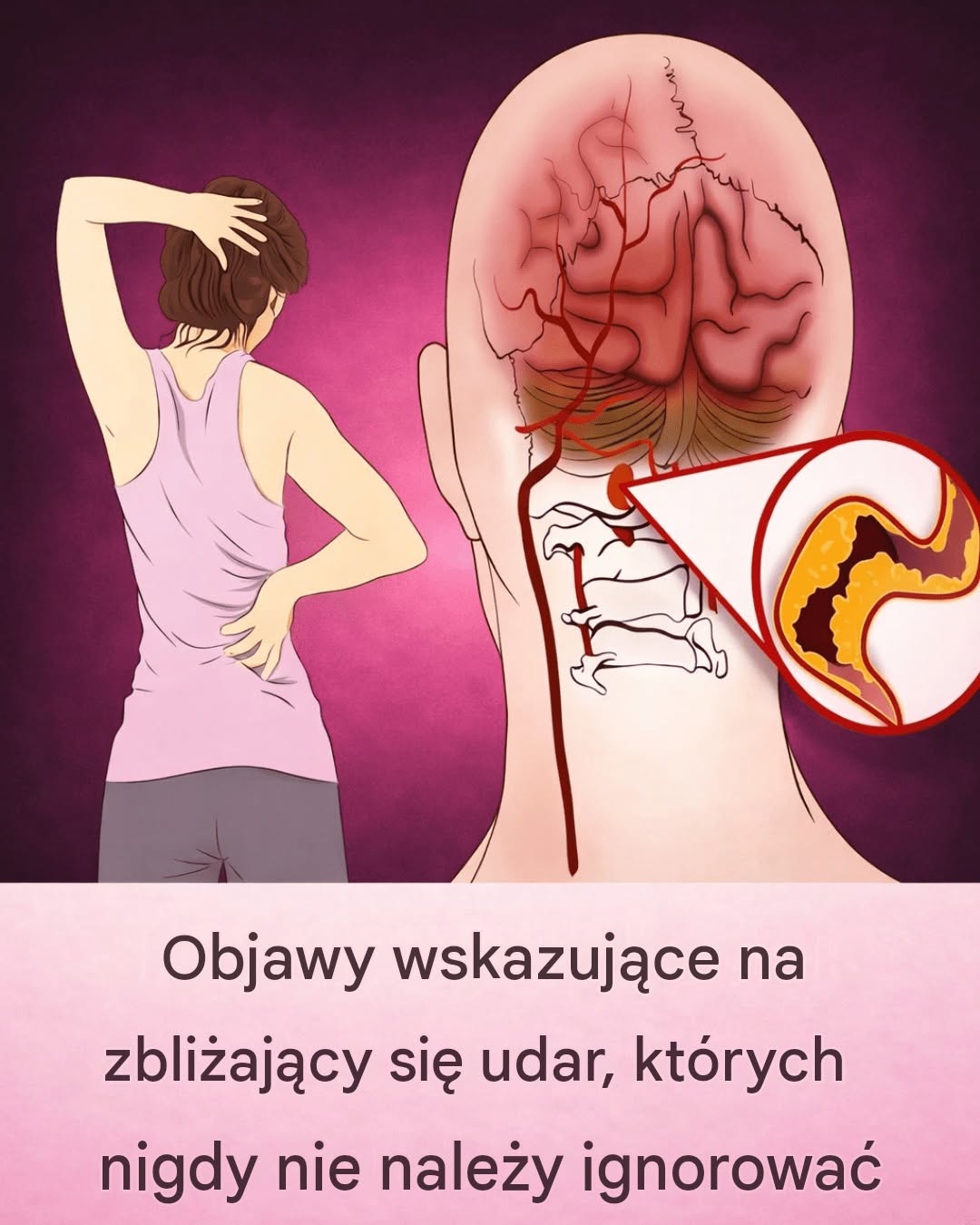 10 wczesnych objawów udaru mózgu, które każdy powinien znać, aby podjąć natychmiastowe działania